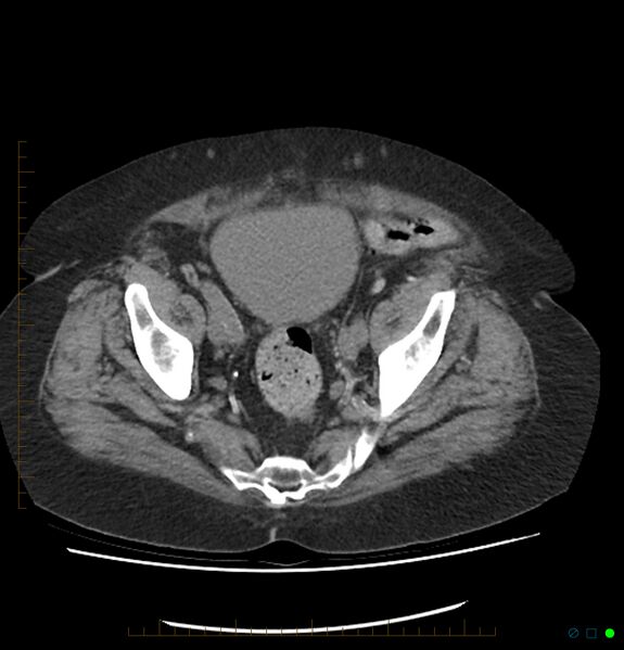 File:Acute renal failure post IV contrast injection- CT findings (Radiopaedia 47815-52557 Axial non-contrast 68).jpg