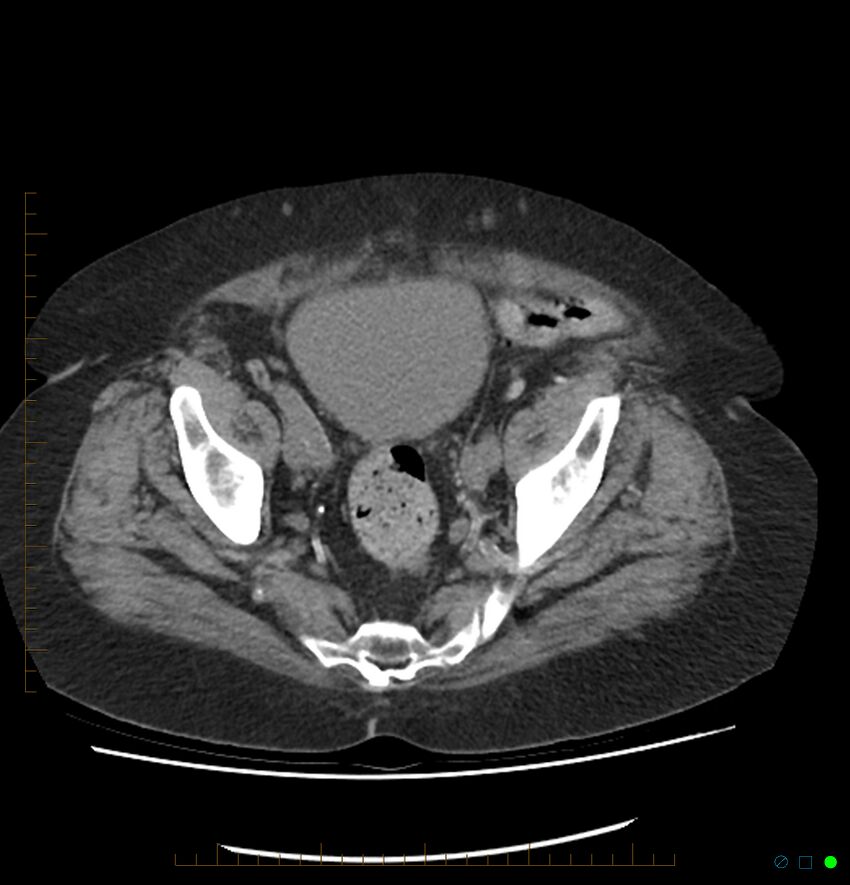 Acute renal failure post IV contrast injection- CT findings (Radiopaedia 47815-52557 Axial non-contrast 68).jpg