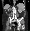 Acute renal failure post IV contrast injection- CT findings (Radiopaedia 47815-52559 Coronal C+ portal venous phase 25).jpg