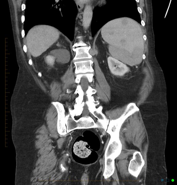 File:Acute renal failure post IV contrast injection- CT findings (Radiopaedia 47815-52559 Coronal C+ portal venous phase 25).jpg