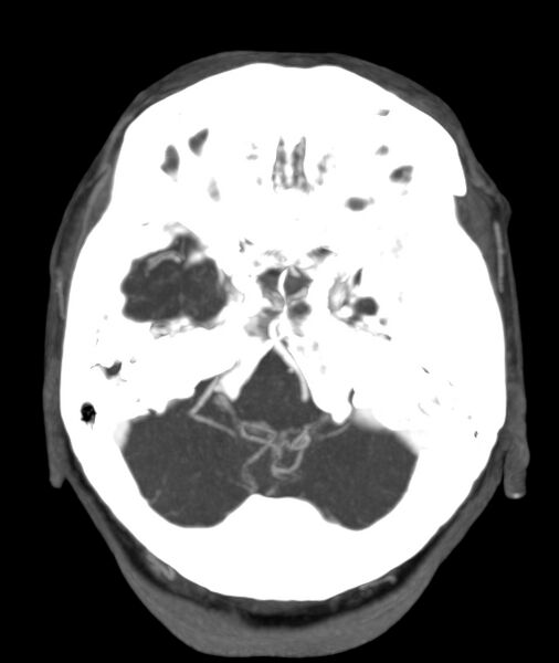 File:Acute right MCA M1 occlusion (Radiopaedia 62268-70454 Axial Phase 2 23).jpg