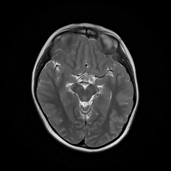 File:Adamantinomatous craniopharyngioma (Radiopaedia 77407-89529 Axial T2 11).jpg