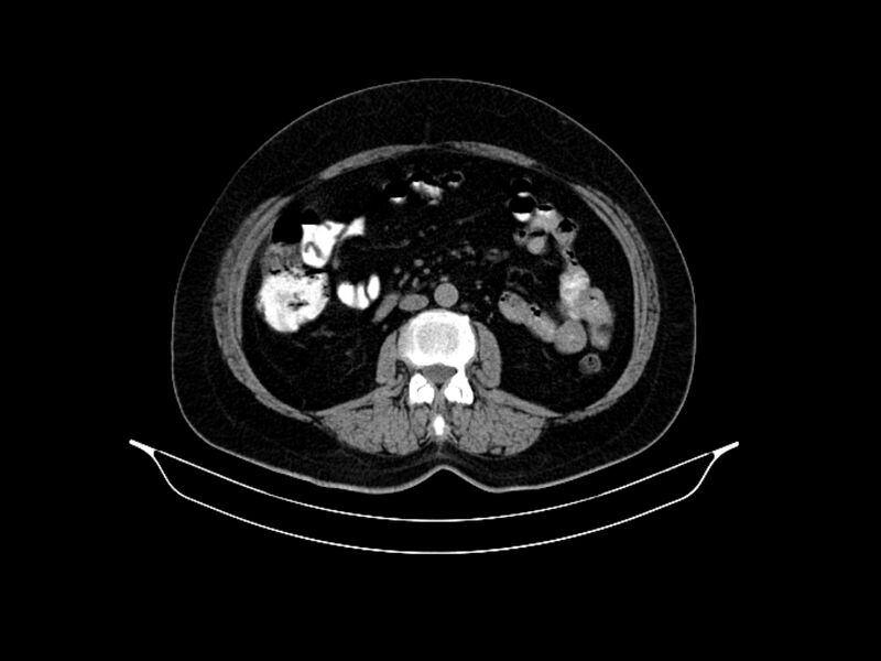 File:Adenocarcinoma of pancreas with hepatic metastasis (Radiopaedia 64332-73122 Axial non-contrast 54).jpg