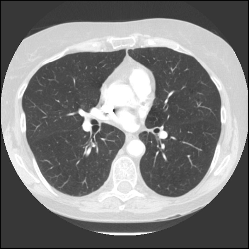Adenocarcinoma of the lung (Radiopaedia 41015-43755 Axial lung window 63).jpg