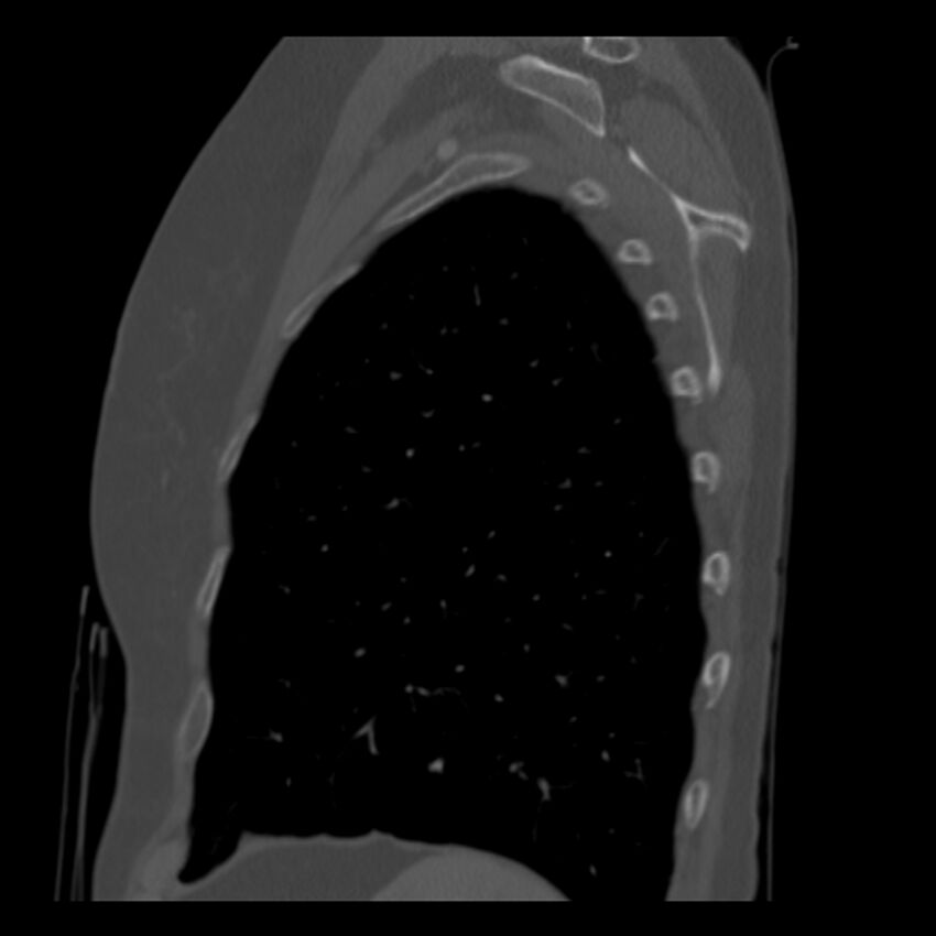 Adenocarcinoma of the lung (Radiopaedia 41015-43755 Sagittal bone window 92).jpg