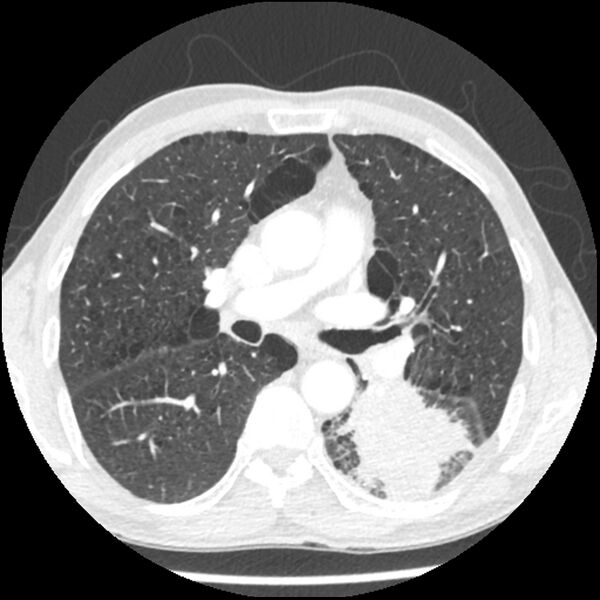 File:Adenocarcinoma of the lung - micropapillary predominant (Radiopaedia 42446-45563 C 37).jpg