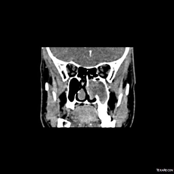 File:Adenoid cystic carcinoma involving paranasal sinus (Radiopaedia 16580-16283 Coronal C+ arterial phase 3).jpeg