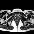Adenomyoma of the uterus (huge) (Radiopaedia 9870-10438 Axial T2 3).jpg