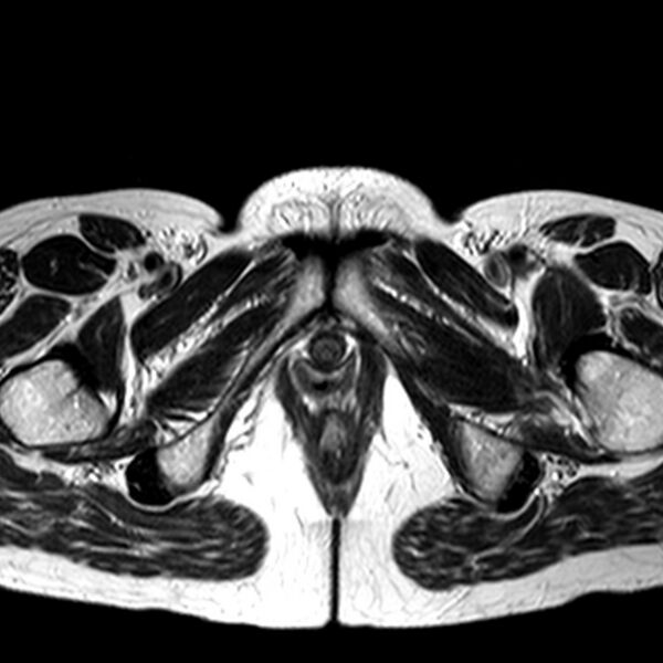 File:Adenomyoma of the uterus (huge) (Radiopaedia 9870-10438 Axial T2 3).jpg
