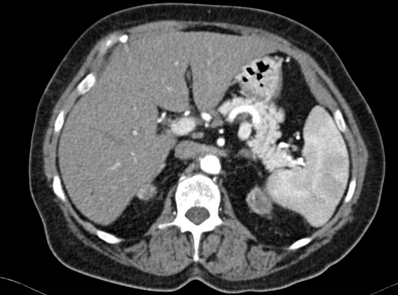File:Adenomyomatosis of the gallbladder (Radiopaedia 12142-12483 Axial C+ arterial phase 1).jpg