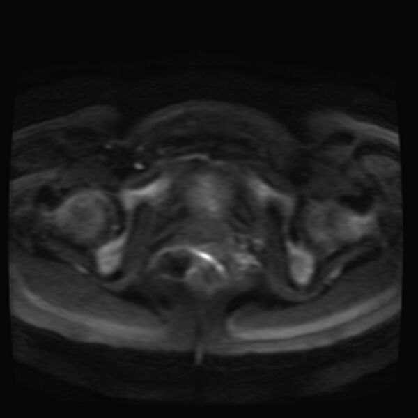 File:Adenomyosis on MRI (Radiopaedia 29328-29780 Axial DWI 12).jpg