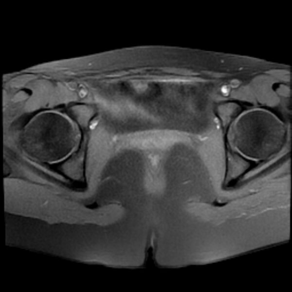 File:Adenomyosis within a septate uterus (Radiopaedia 69963-79981 Axial T1 fat sat 22).jpg