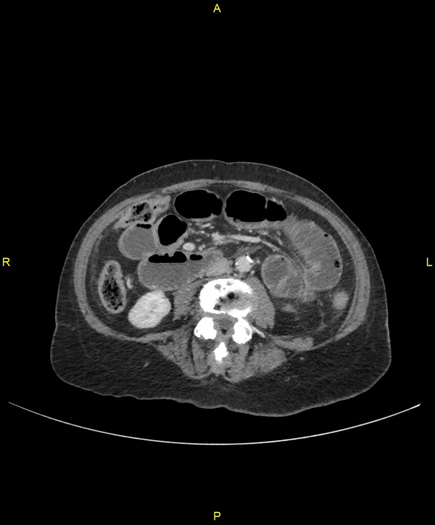 Adhesional small bowel obstruction (Radiopaedia 85402-101024 Axial C+ portal venous phase 150).jpg