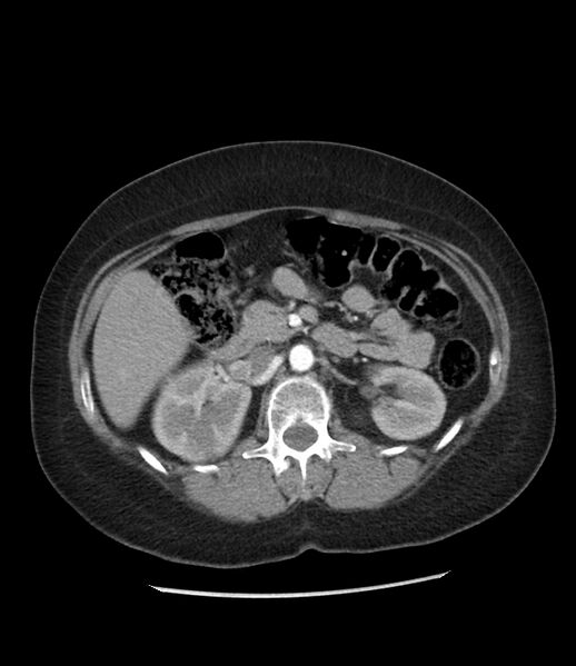 File:Adrenal cortical carcinoma with IVC invasion and thrombosis (Radiopaedia 34307-35597 Axial C+ arterial phase 35).jpg