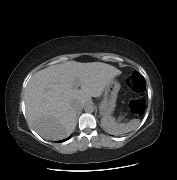 File:Adrenal cortical carcinoma with IVC invasion and thrombosis (Radiopaedia 34307-35597 Axial non-contrast 7).jpg