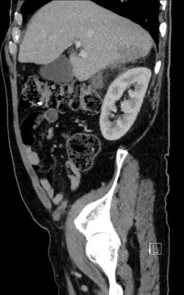 File:Adrenal lymphoma (Radiopaedia 73730-84529 Sagittal C+ portal venous phase 30).jpg