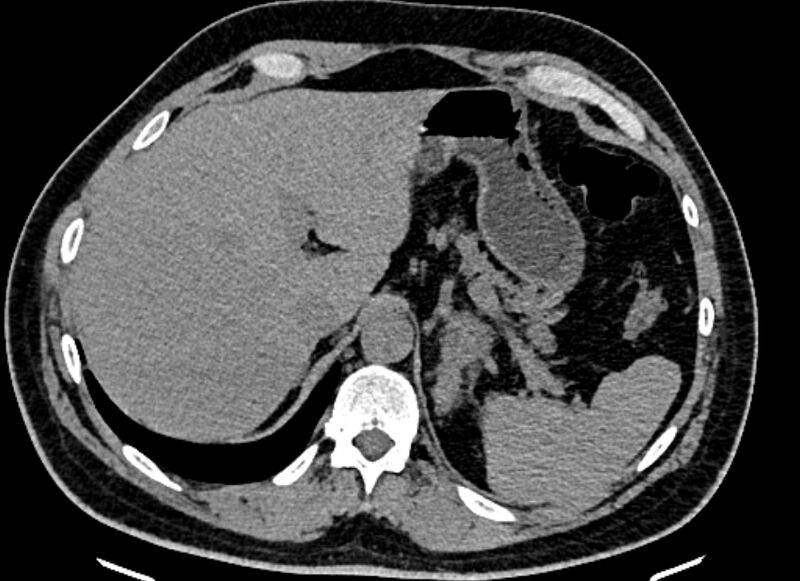 File:Adrenal metastases (Radiopaedia 73082-83791 Axial non-contrast 37).jpg