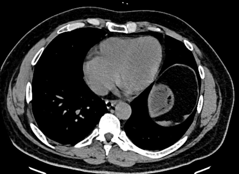 File:Adrenal metastases (Radiopaedia 73082-83791 Axial non-contrast 5).jpg