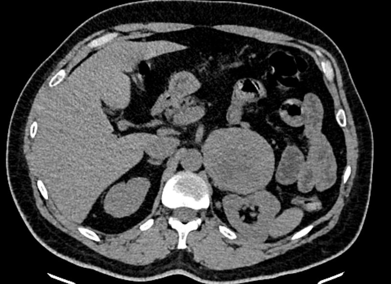 File:Adrenal metastases (Radiopaedia 73082-83791 Axial non-contrast 56).jpg