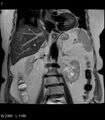 Adrenal myelolipoma (Radiopaedia 6765-7961 Coronal T2 7).jpg