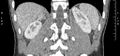Adrenal pheochromocytoma (Radiopaedia 35133-36726 Coronal C+ portal venous phase 4).jpg
