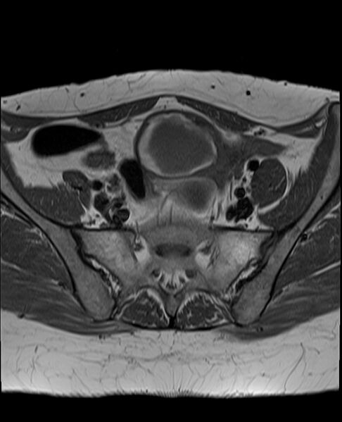 File:Adult granulosa cell tumor of the ovary (Radiopaedia 71581-81950 Axial T1 9).jpg