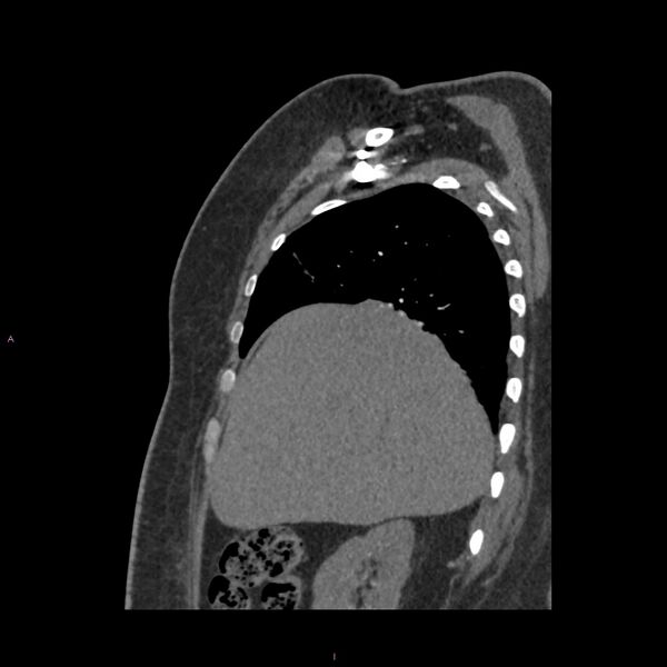File:Agenesis of the left hepatic lobe (Radiopaedia 77284-89359 Sagittal C+ CTPA 26).jpg