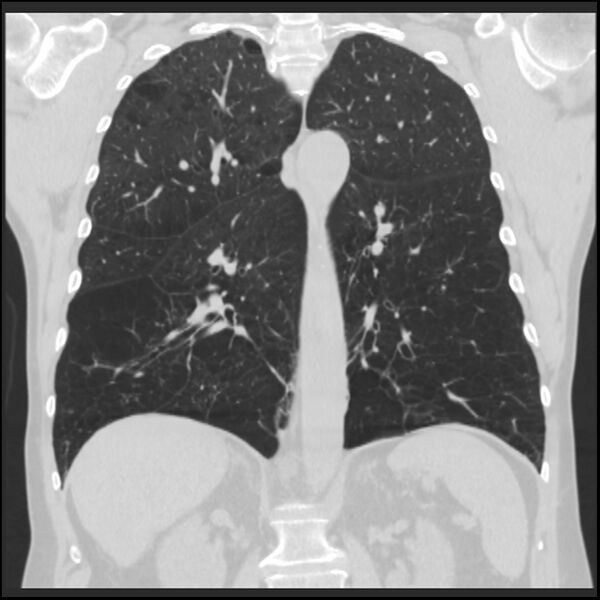 File:Alpha-1-antitrypsin deficiency (Radiopaedia 40993-43722 Coronal lung window 65).jpg
