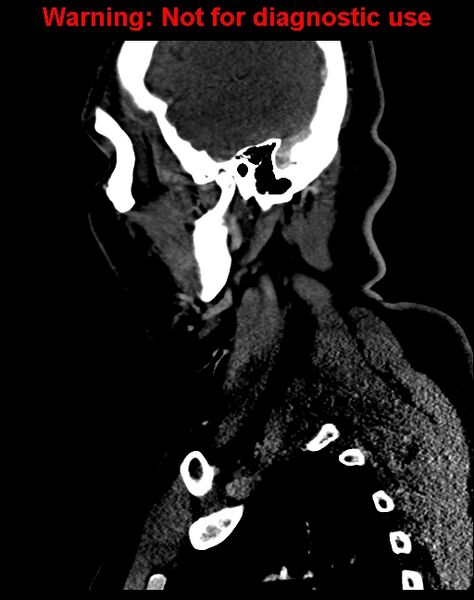 File:Ameloblastoma (Radiopaedia 33126-34164 F 54).jpg