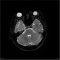 Amnestic syndrome secondary to hypoxic brain injury (Radiopaedia 24743-25004 DWI 42).jpg