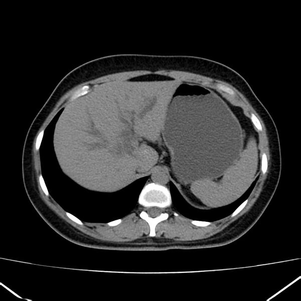 File:Ampullary tumor (Radiopaedia 22787-22816 Axial non-contrast 12).jpg