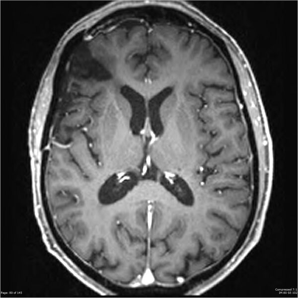 File:Anaplastic meningioma with recurrence (Radiopaedia 34452-35788 Axial T1 C+ 80).jpg