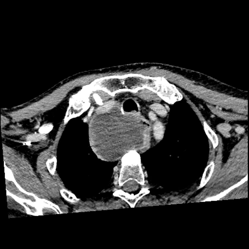Anaplastic thyroid carcinoma (Radiopaedia 79087-92034 B 20).jpg