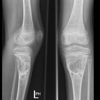 X-ray: ABC large long bone of lower leg near knee