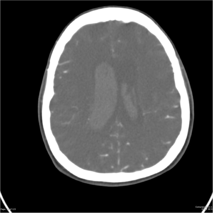 Aneurysmal subarachnoid hemorrhage and Moya Moya disease (Radiopaedia 34306-35593 Axial CT COW 21).jpg
