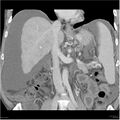 Annular pancreas and cirrhosis (Radiopaedia 24561-24843 B 12).jpg