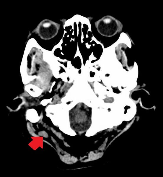 File:Anomalous intracranial venous drainage (Radiopaedia 28161-28418 C 1).jpg