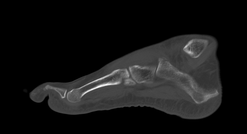 File:Anterior calcaneal process fracture (Radiopaedia 47384-51989 Sagittal bone window 10).png