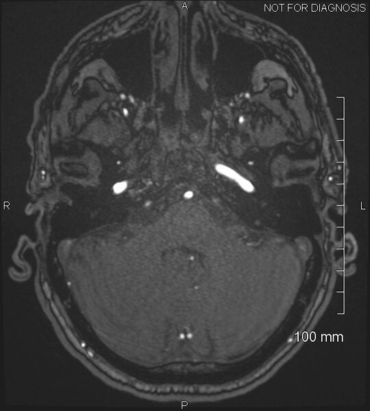 File:Anterior cerebral artery aneurysm (Radiopaedia 80683-94127 Axial MRA 47).jpg