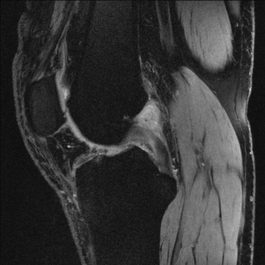 Anterior cruciate ligament mucoid degeneration (Radiopaedia 68400-77933 Sagittal 36).jpg