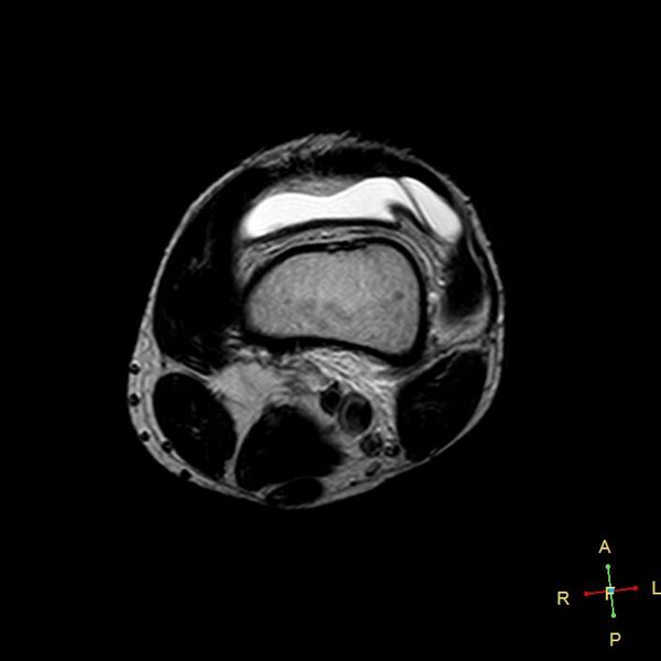 File:Anterior cruciate ligament tear - complete (Radiopaedia 24907-25170 T2 17).jpg
