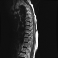 Anterior spinal artery syndrome (Radiopaedia 46335-50750 C 1).png