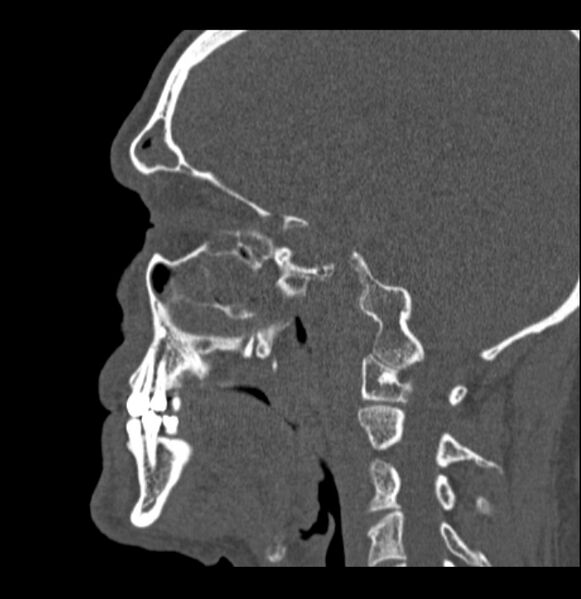 File:Antrochoanal polyp (Radiopaedia 79011-92169 Sagittal bone window 14).jpg