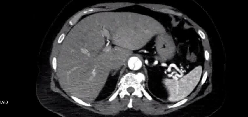 Aortic Dissection (Radiopaedia 85272-100847 A 44).jpg