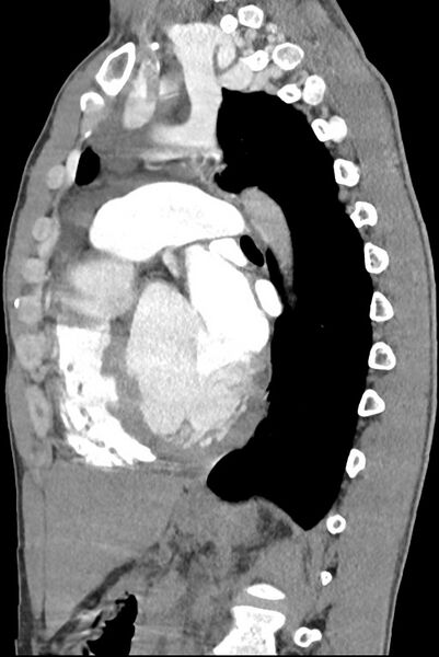 File:Aortic coarctation with aneurysm (Radiopaedia 74818-85828 B 97).jpg