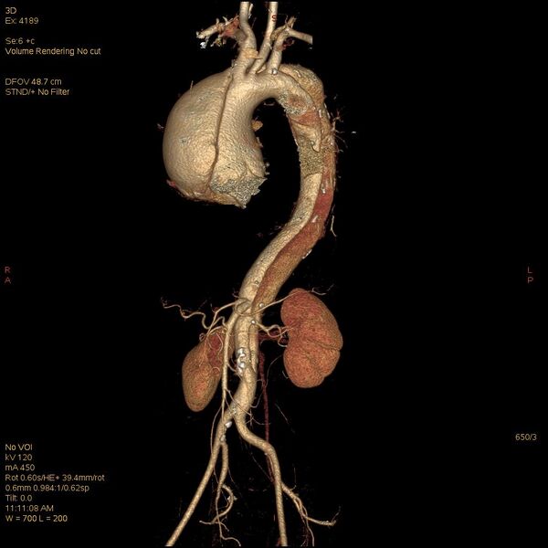 File:Aortic dissection (Radiopaedia 25350-25604 E 3).jpg