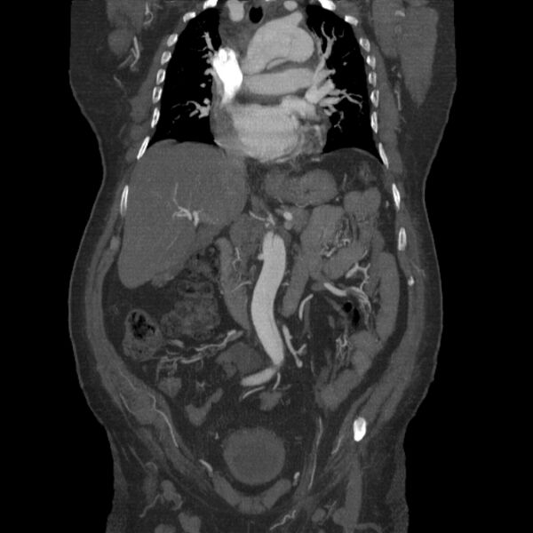 File:Aortic dissection (Radiopaedia 28802-29105 B 14).jpg