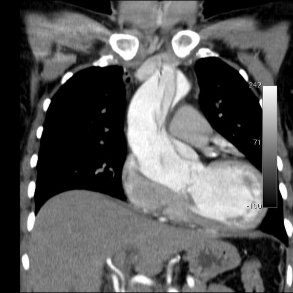 File:Aortic dissection - Stanford type A (Radiopaedia 29247-29659 B 24).jpg