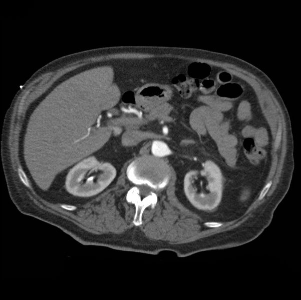 File:Aortic dissection with rupture into pericardium (Radiopaedia 12384-12647 A 59).jpg