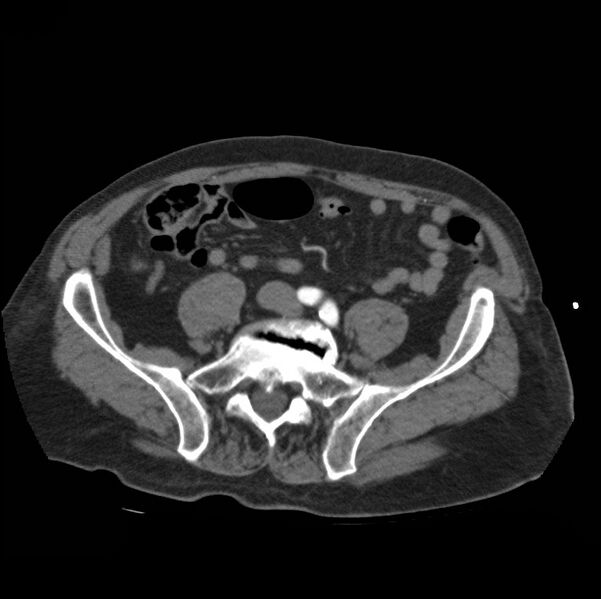 File:Aortic dissection with rupture into pericardium (Radiopaedia 12384-12647 A 74).jpg